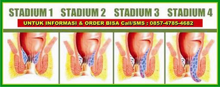 Illustration for article titled obat wasir ampuh cepat sembuh